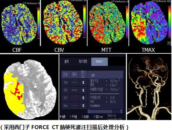 1704873841154207.jpg 腦灌注2.jpg