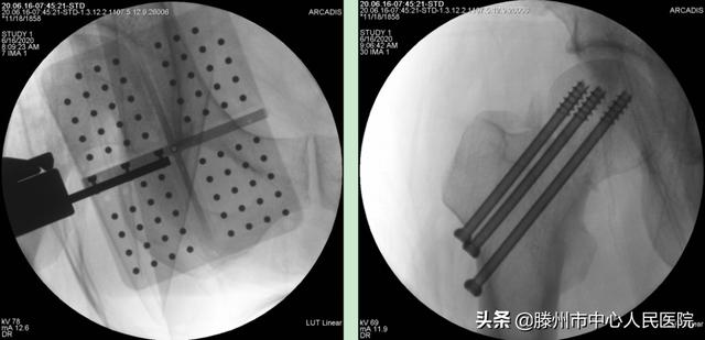 滕州市中心人民醫(yī)院成功完成骨科機器人手術(shù)