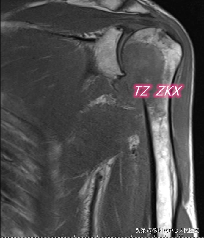 CT引導(dǎo)微波消融聯(lián)合鋼筋混凝土技術(shù)治療肱骨轉(zhuǎn)移技術(shù)在滕州開展
