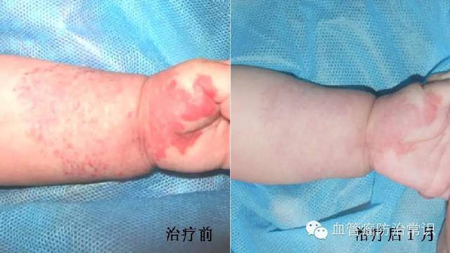 修殘補(bǔ)缺道 醫(yī)美整形路——幫寶寶遠(yuǎn)離紅斑-血管瘤