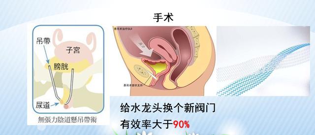 咳嗽、大笑……滴滴答答的尷尬，關于尿失禁的那些事