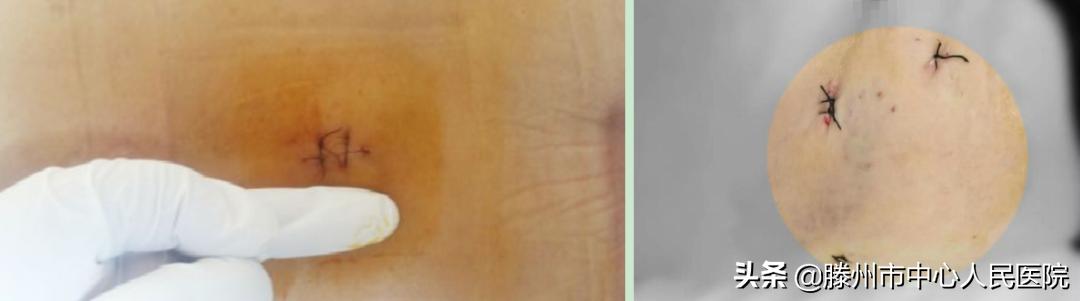 滕州市中心人民醫(yī)院成功完成骨科機器人手術(shù)