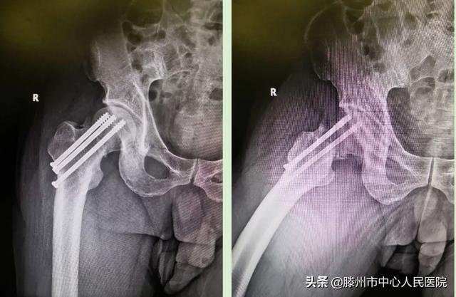 滕州市中心人民醫(yī)院成功完成骨科機器人手術(shù)