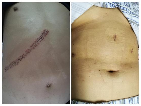 肝膽血管外科獨(dú)立開(kāi)展腹腔鏡下肝血管瘤切除術(shù)