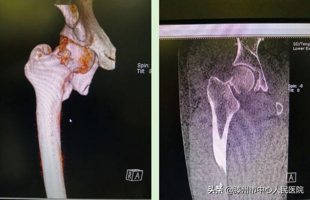 滕州市中心人民醫(yī)院成功完成骨科機器人手術(shù)