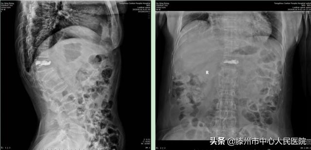滕州市中心人民醫(yī)院成功完成骨科機器人手術(shù)