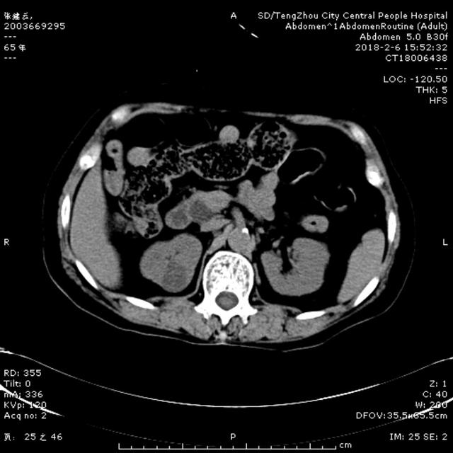 急診ERCP，讓生命垂?；颊咿D(zhuǎn)危為安