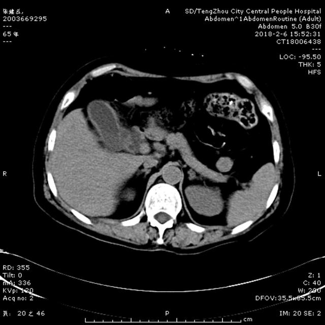 急診ERCP，讓生命垂?；颊咿D(zhuǎn)危為安