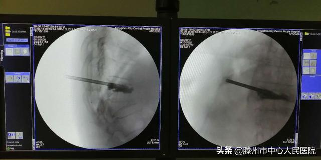 滕州市中心人民醫(yī)院成功完成骨科機器人手術(shù)