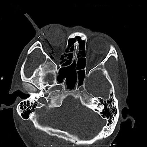 眼二科：鋼筆戳入眼瞼，手術(shù)6小時順利取出，患者眼球保住