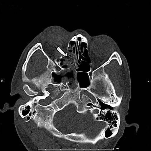 眼二科：鋼筆戳入眼瞼，手術(shù)6小時順利取出，患者眼球保住