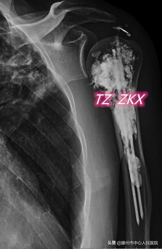 CT引導(dǎo)微波消融聯(lián)合鋼筋混凝土技術(shù)治療肱骨轉(zhuǎn)移技術(shù)在滕州開展