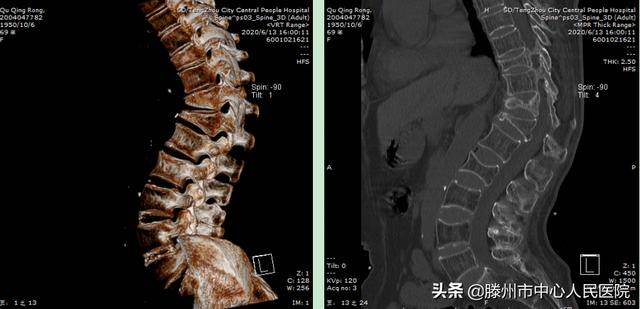 滕州市中心人民醫(yī)院成功完成骨科機器人手術(shù)