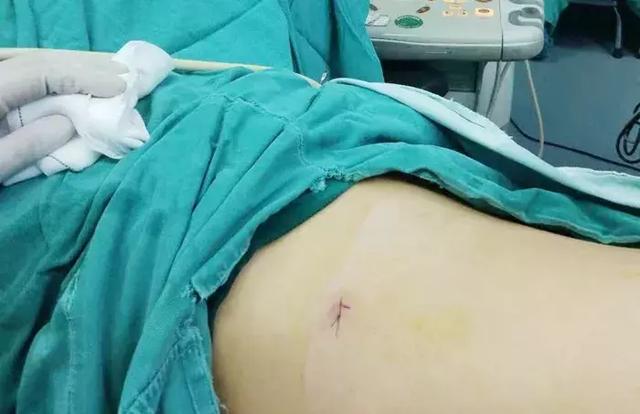 泌尿外科成功實(shí)施我院首例無管化經(jīng)皮腎鏡碎石取石術(shù)