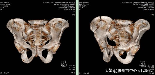 滕州市中心人民醫(yī)院成功完成骨科機器人手術(shù)